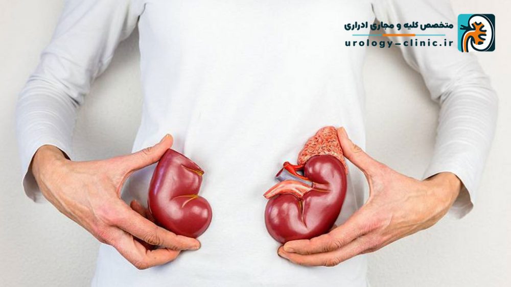 تنگی حالب چیست و چگونه می توان آن را درمان کرد؟
