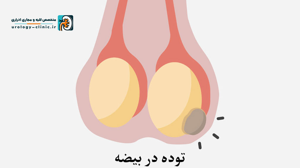 علل اصلی سرطان بیضه چیست؟