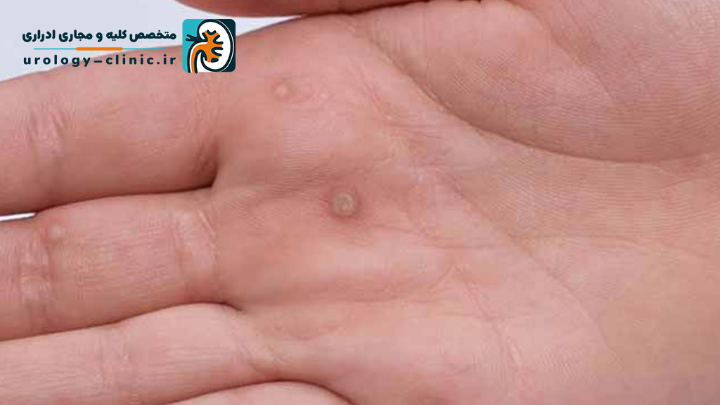 تفاوت زگیل و تبخال تناسلی از نظر علائم چیست؟